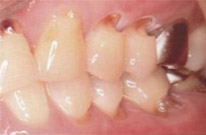 3.歯の根本が割れる